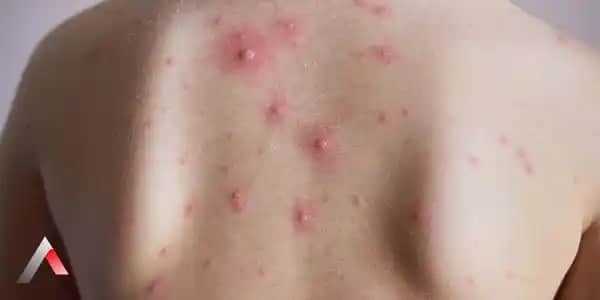 Ciltte Minik Kabarcıklar ve Kaşıntı Nedenleri, Belirtileri ve Çözüm Yolları