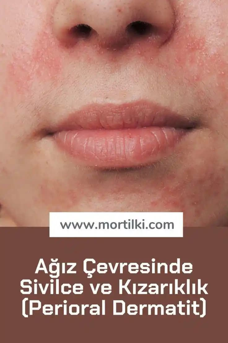 Ciltte Nokta Nokta Kızarıklıkların Nedenleri ve Etkili Çözüm Yolları