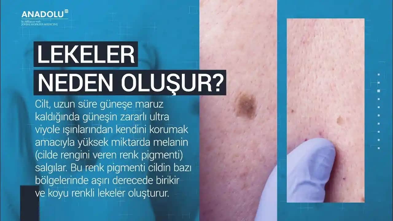 Ciltte Pul Pul Lekelerin Nedenleri ve Etkili Tedavi Yöntemleri Hakkında Kapsamlı Bilgi