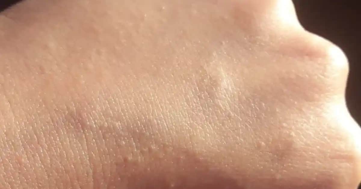 Ciltte Pütürcükler Nedenleri Belirtileri ve Etkili Çözüm Yolları