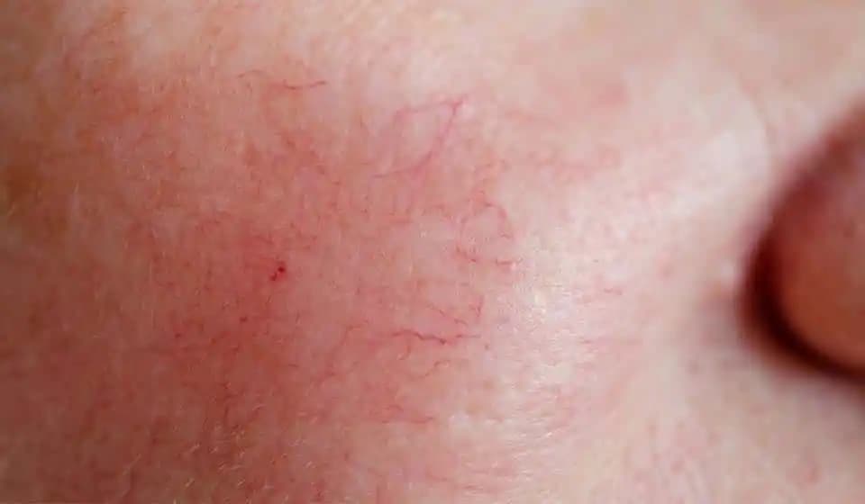 Ciltte Rozanın Belirtileri, Nedenleri ve Etkili Tedavi Yöntemleri