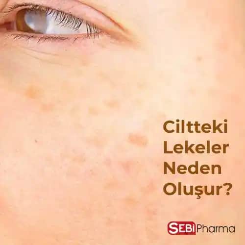 Ciltte Sarı Leke Nedenleri ve Etkili Tedavi Yöntemleri Hakkında Kapsamlı Bilgi