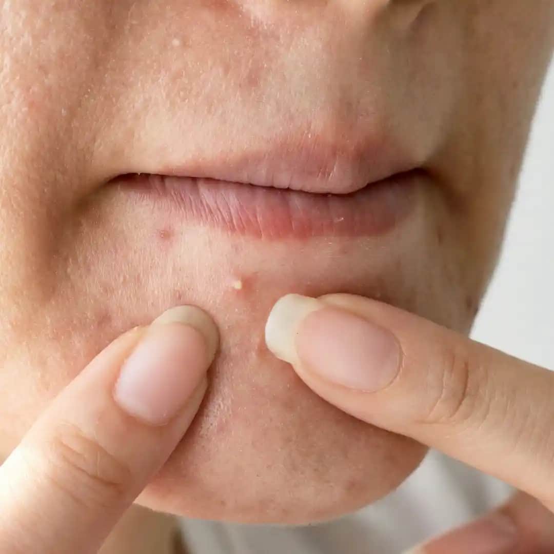 Ciltte Sivilce Nedenleri, Türleri ve Etkili Çözüm Yolları Hakkında Kapsamlı Bilgi