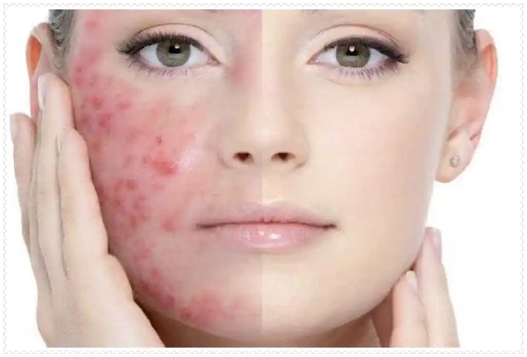 Ciltte Sivilceler Neden Oluşur ve Etkili Önleme Yöntemleri Nelerdir