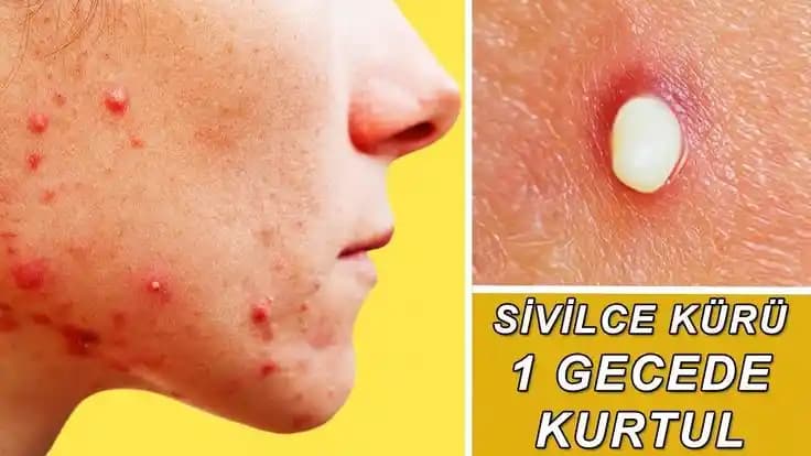 Ciltte Sivilceleri Kontrol Altına Almanın Etkili Kozmetik Yöntemleri ve İpuçları