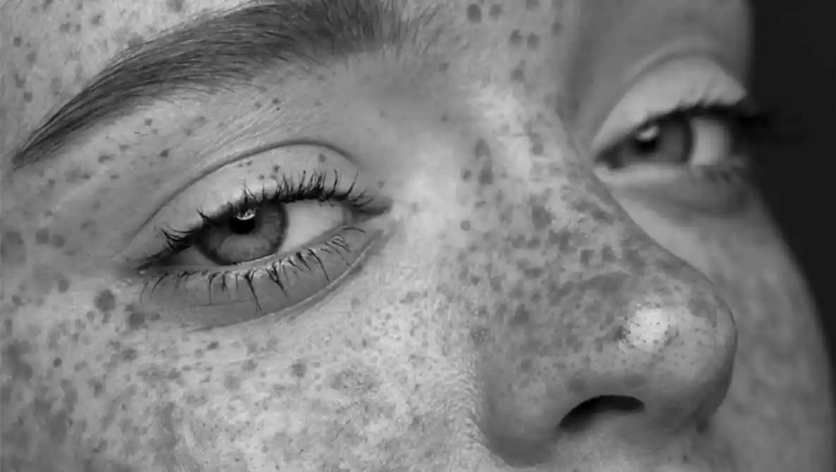 Ciltte Siyah Lekeler: Nedenleri, Çözüm Yöntemleri ve Bakım İpuçları