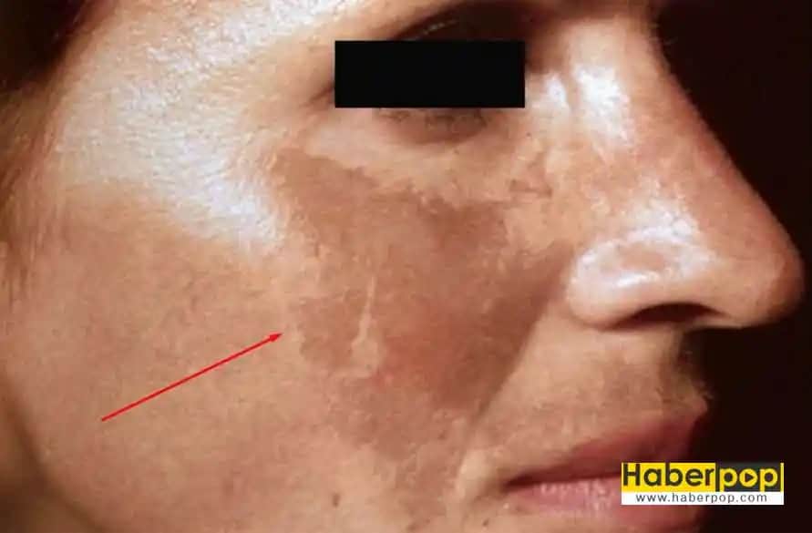 Ciltte Siyah Lekeler: Nedenleri, Türleri ve Etkili Çözüm Yöntemleri