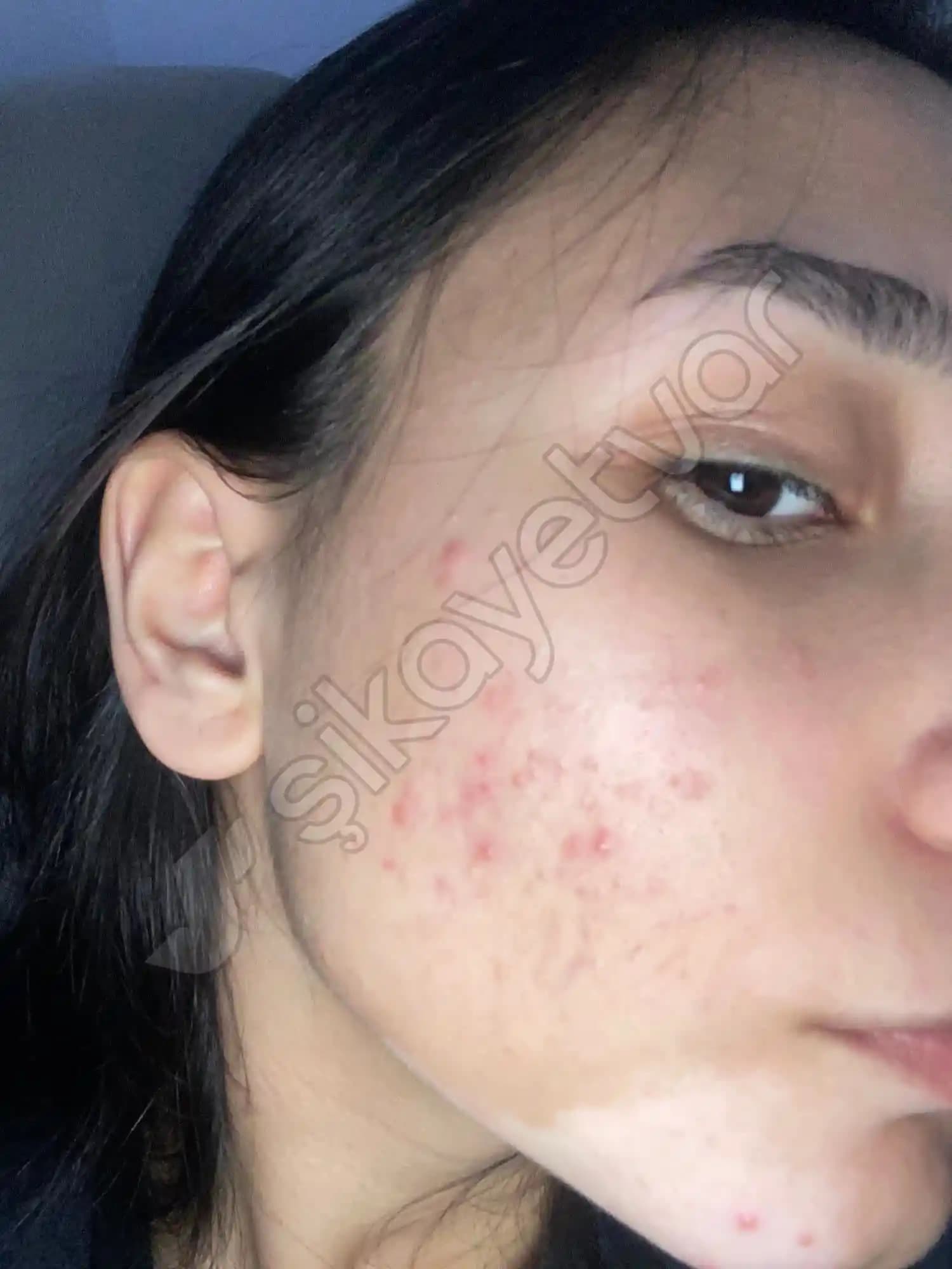 Ciltte Sürekli Sivilce Çıkması Nedenleri ve Etkili Çözüm Yolları