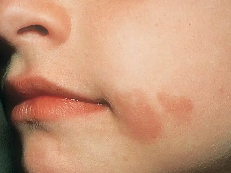 Ciltte Yanık Gibi Lekelerin Nedenleri ve Etkili Tedavi Yöntemleri