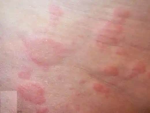 Ciltteki Kırmızı Kabarcıkların Nedenleri ve Etkili Tedavi Yöntemleri