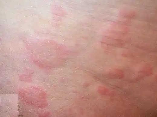 Ciltteki Kırmızı Kabarcıkların Nedenleri ve Etkili Tedavi Yöntemleri