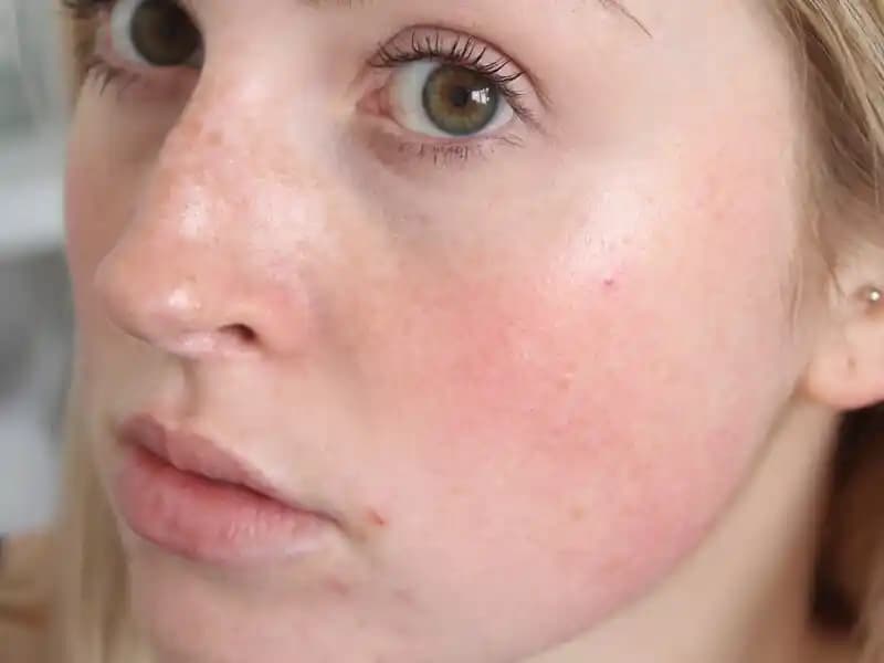 Ciltteki Kırmızı Lekelere Karşı Etkili Çözüm Yolları ve Bakım Önerileri