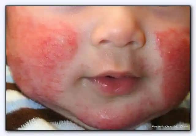 Çocuklarda Kafada Egzama: Nedenleri, Belirtileri ve Kozmetik Yaklaşımlar