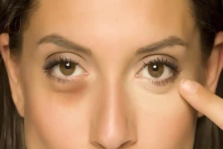 D vitamini eksikliği ve göz altı morlukları: etkileri, nedenleri ve çözüm önerileri