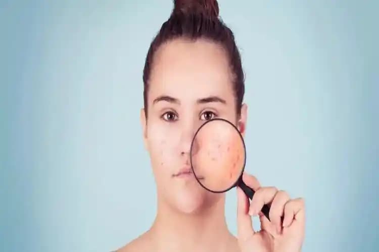 D vitamini eksikliği ve sivilceler: cilt sağlığını etkileyen önemli faktörler hakkında detaylar