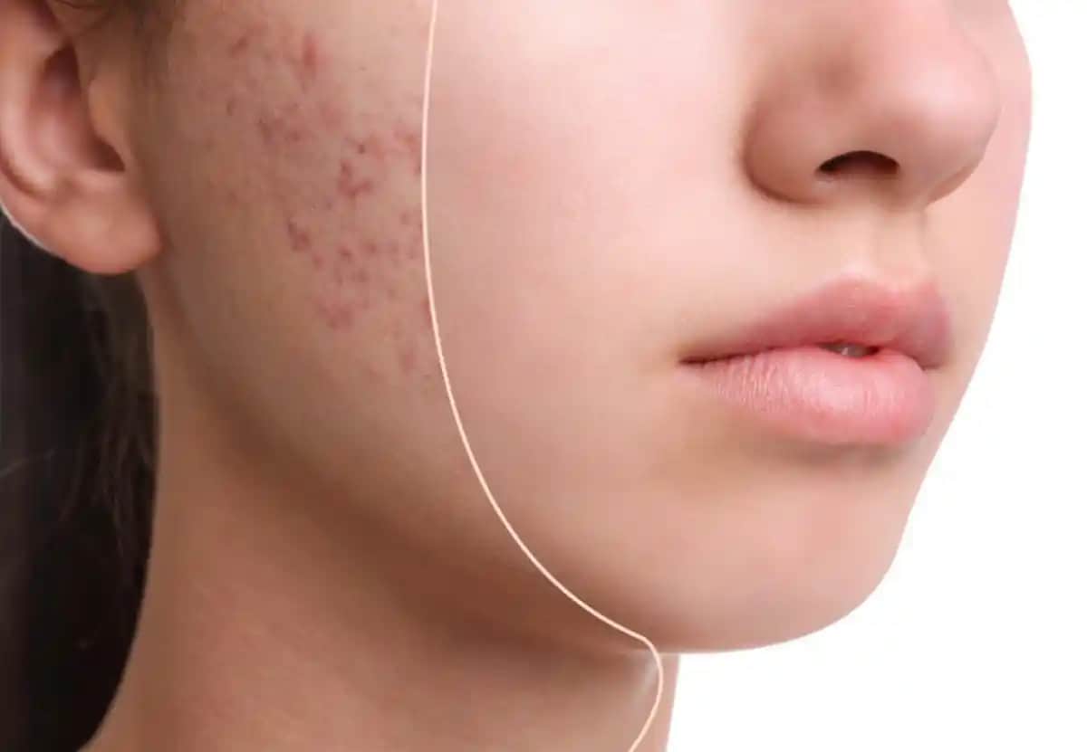 Deri Altı Akne Nedir, Belirtileri ve Etkili Tedavi Yöntemleri Hakkında Bilmeniz Gerekenler