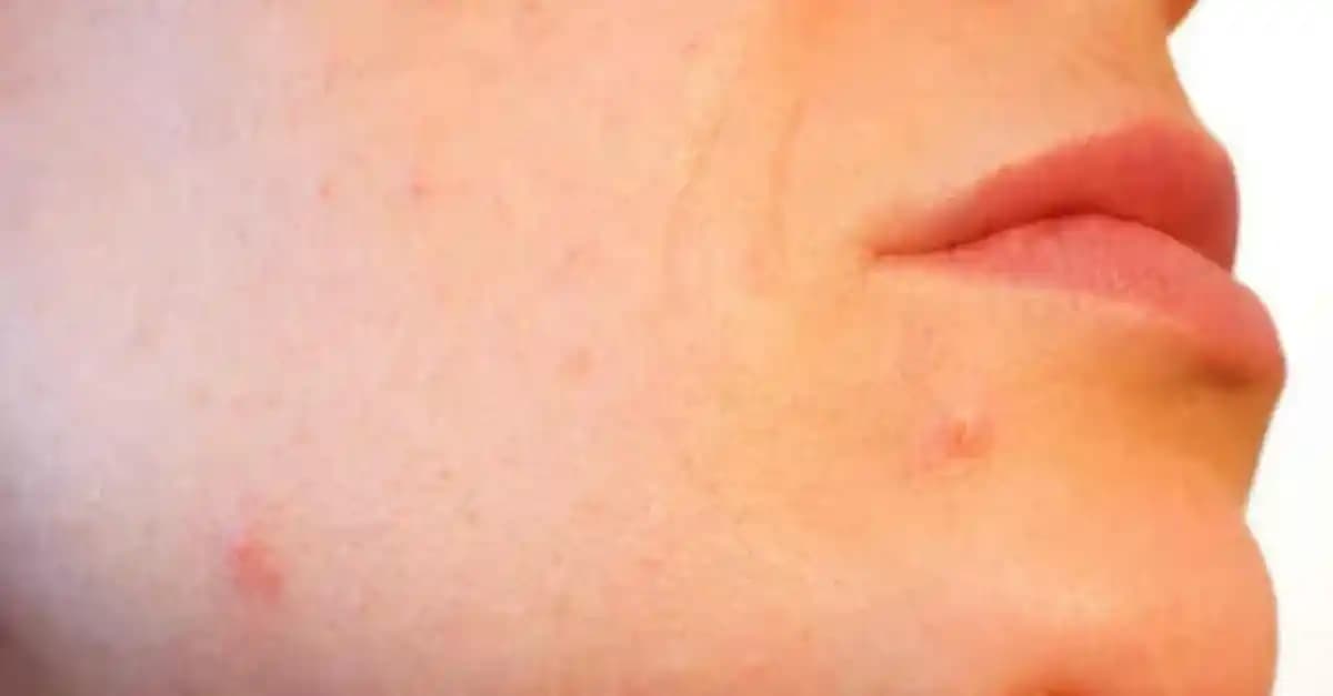 Deri Altı Şişlikleri ve Sivilceler: Kozmetik Yaklaşımlar ve Doğal Çözümler