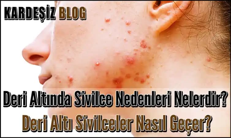 Deri Altı Sivilcelerinin Nedenleri ve Etkili Bakım Yöntemleri Hakkında Kapsamlı Rehber