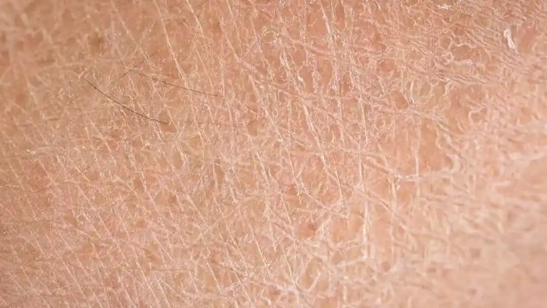 Deri Kuruluğu Nedenleri ve Cilt Sağlığını Koruma Yöntemleri Rehberi