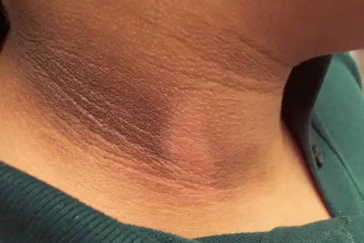 Deride Kararma Nedenleri, Çözümleri ve Güzellik Sırları Hakkında Kapsamlı Bilgi