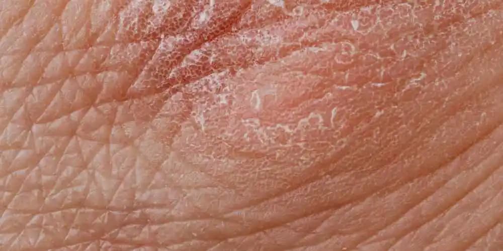 Dermatit Çeşitleri ve Cilt Sağlığını Koruma Yöntemleri Hakkında Bilgiler