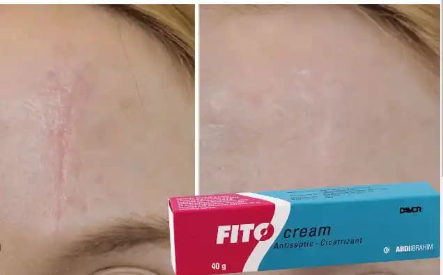 Dikiş Alındıktan Sonra Cilt Bakımı ve Krem Kullanımı Rehberi