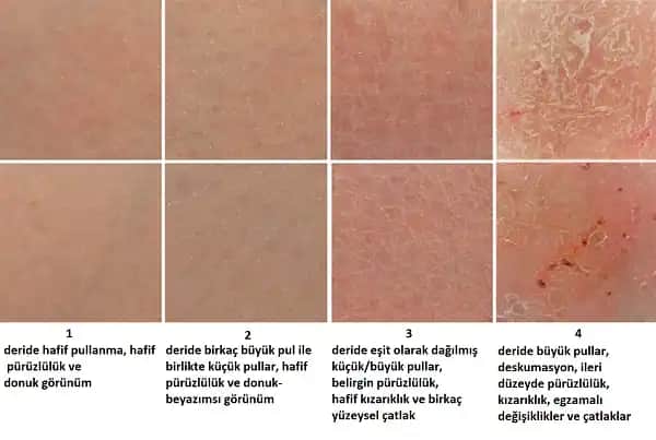 Dikiş Kaşıntısı Nedenleri ve Modern Çözüm Yöntemleri Hakkında Bilgilendirici Rehber