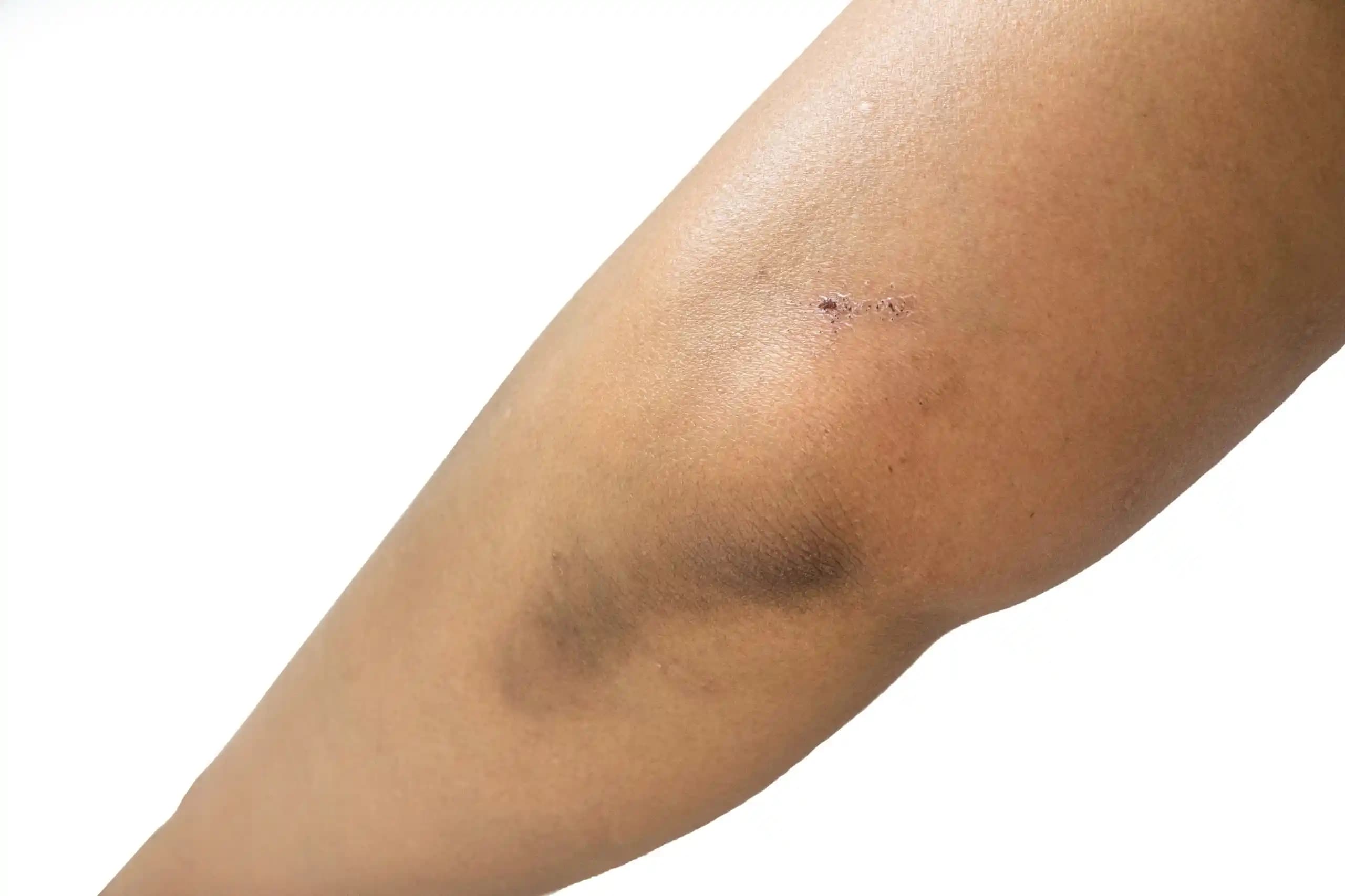 Dirsek Kararmasının Nedenleri ve Kozmetik Çözümlerle Gelişmiş Bakım Yöntemleri