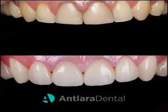 Diş Diplerindeki Sarı Lekeler ve Etkili Temizlik ile Kozmetik Çözüm Yöntemleri