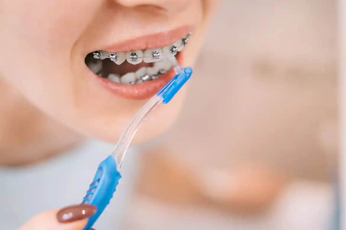 Diş Teli Kullanırken Doğru Fırçalama ve Ağız Bakımı İpuçları