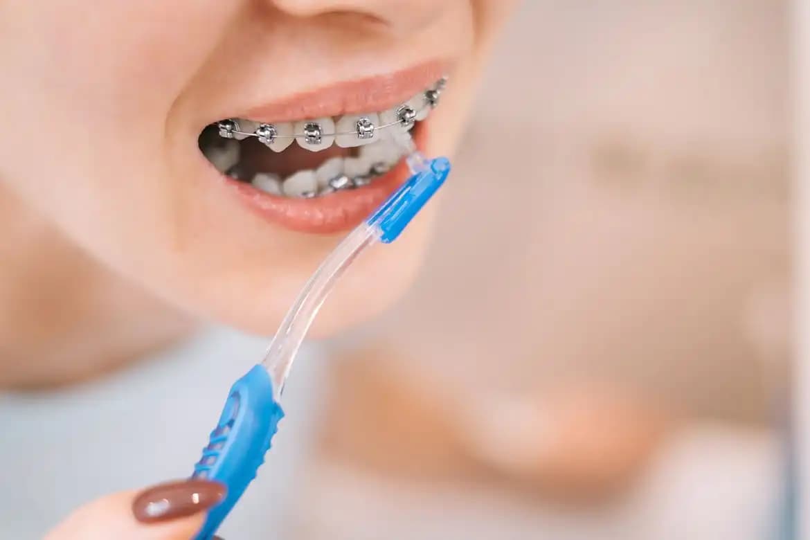Diş Teli Kullanırken Doğru Fırçalama ve Ağız Bakımı İpuçları
