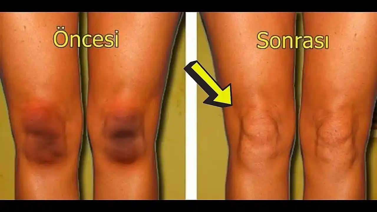 Diz Kapağı Kararması İçin Etkili Çözüm Yöntemleri ve Bakım İpuçları