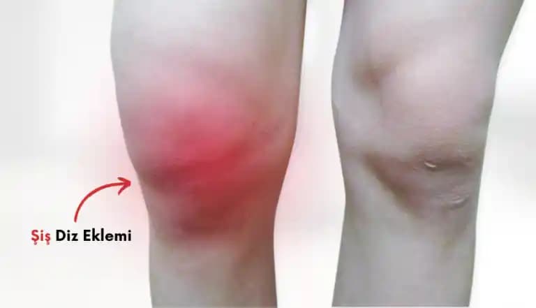 Dizde Kararma Nedenleri ve Etkili Önleme Yöntemleri Hakkında Kapsamlı Rehber