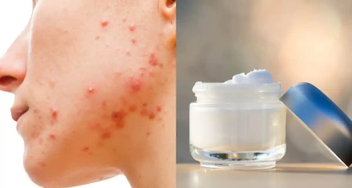 Doğum Sonrası Sivilcelenme ve Cilt Bakımı Yöntemleri Hakkında Kapsamlı Rehber