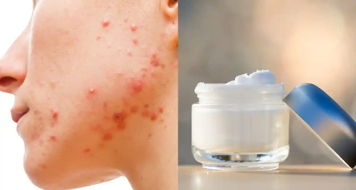 Doğum Sonrası Sivilcelenme ve Cilt Bakımı Yöntemleri Hakkında Kapsamlı Rehber