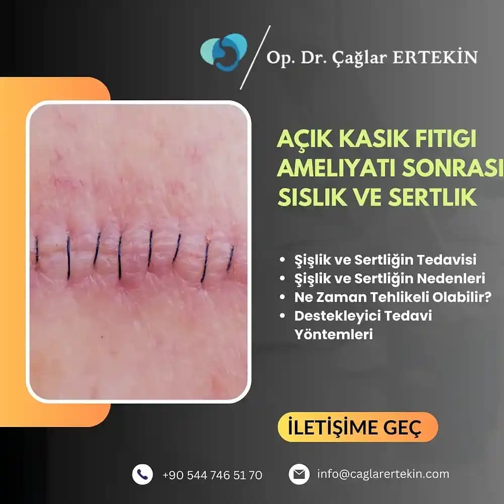 Dövme Sonrası Şişlik ve Kızarıklık Nedenleri ve Etkili Çözüm Yolları