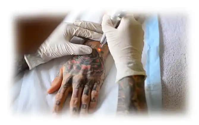 Dövme Yaralarının Özellikleri ve Doğru Bakım Yöntemleri