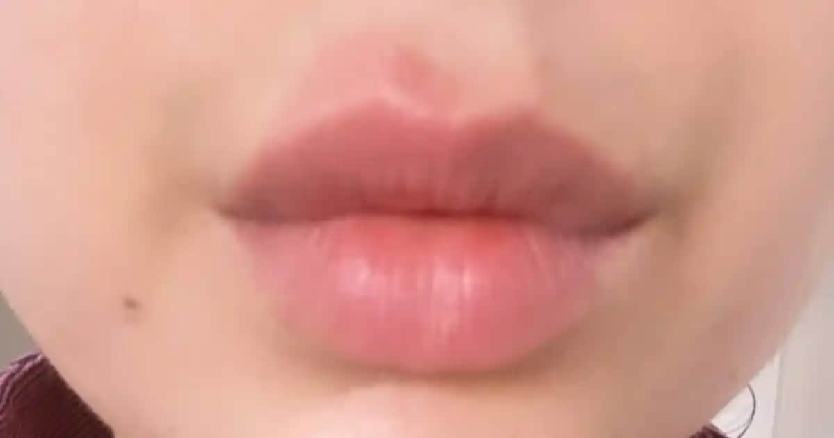 Dudak Altı Kızarıklığının Nedenleri Belirtileri ve Etkili Çözüm Yolları