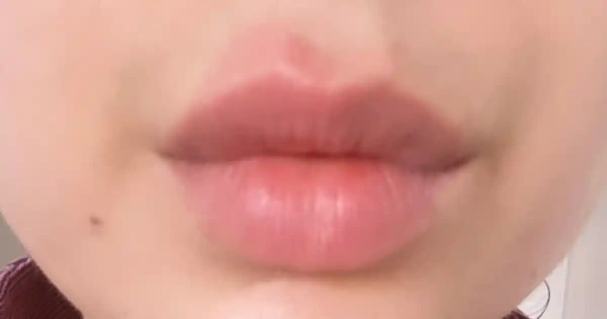 Dudak Altı Kızarıklığının Nedenleri Belirtileri ve Etkili Çözüm Yolları