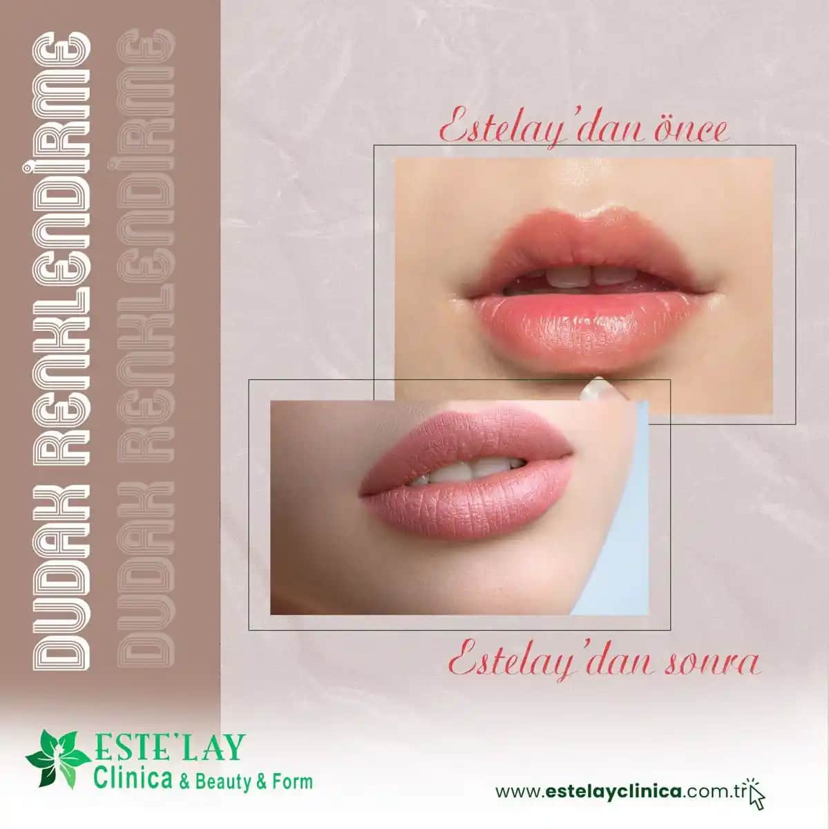 Dudak Çerçevesi Nedir, Nasıl Yapılır ve Güvenli Uygulama Yöntemleri