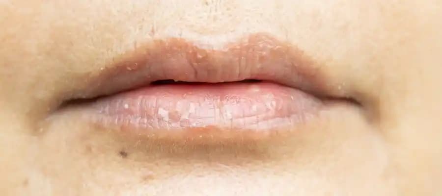 Dudak Çevresi Kararması Nedenleri, Önleme Yöntemleri ve Tedavi Seçenekleri