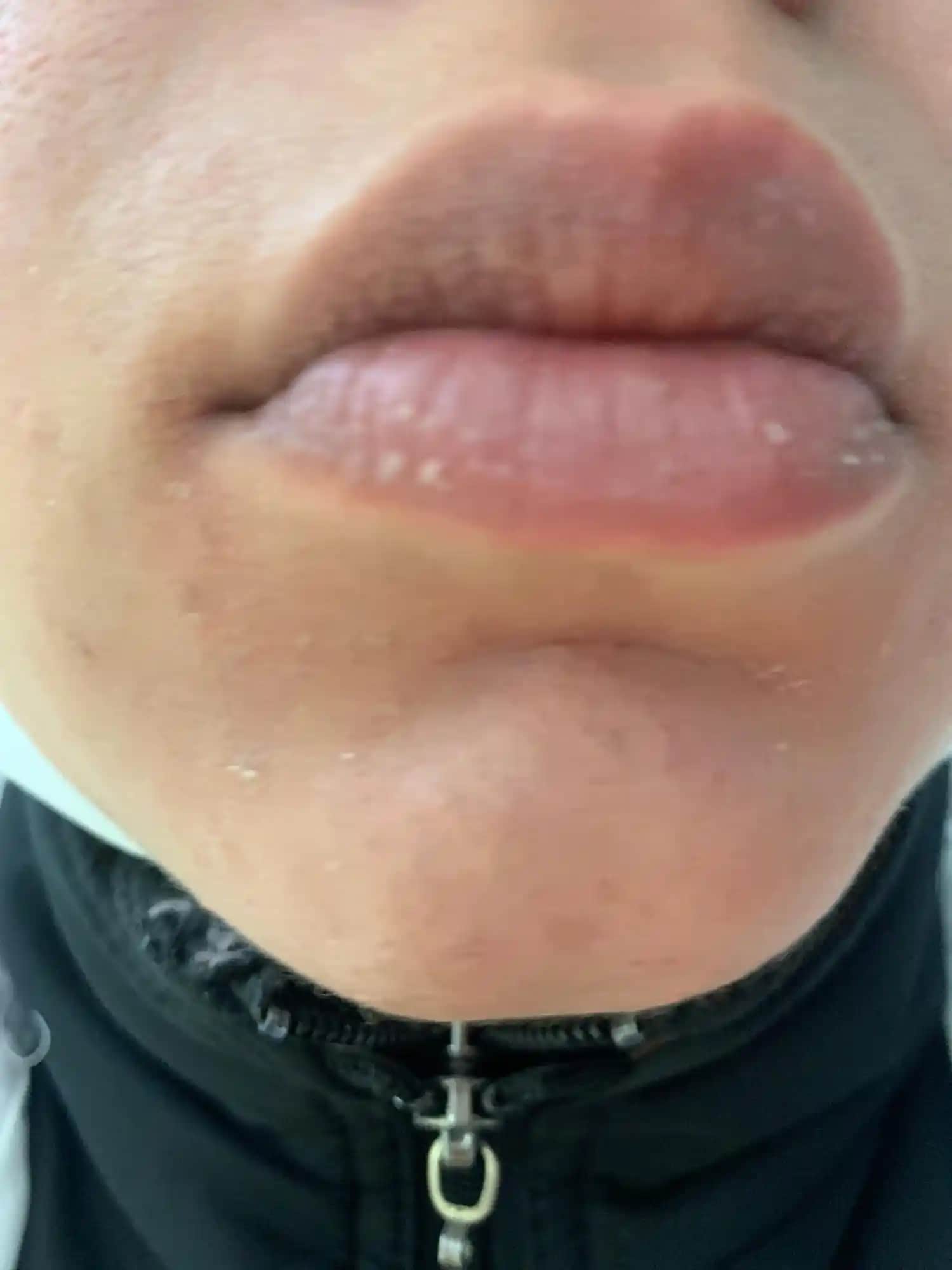 Dudak Kenarı Çatlağı İçin En Etkili Krem Seçenekleri ve Bakım İpuçları