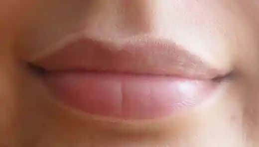 Dudak Kenarı Kızarıklığı Nedenleri ve Etkili Tedavi Yöntemleri Hakkında Bilgi
