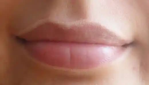 Dudak Kenarı Kızarıklığı Nedenleri ve Etkili Tedavi Yöntemleri Hakkında Bilgi