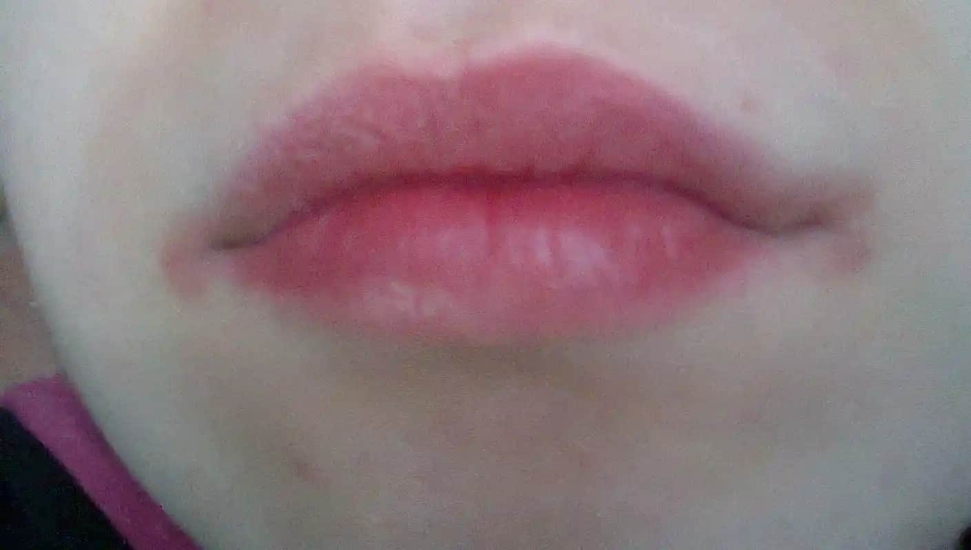 Dudak Kenarında Kızarıklık ve Kuruluk: Nedenleri ve Etkili Çözüm Yöntemleri