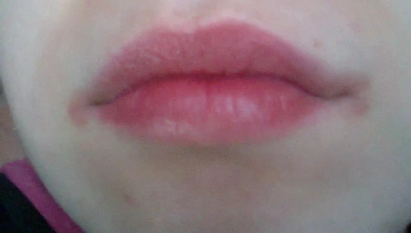 Dudak Kenarında Kızarıklık ve Kuruluk: Nedenleri ve Etkili Çözüm Yöntemleri