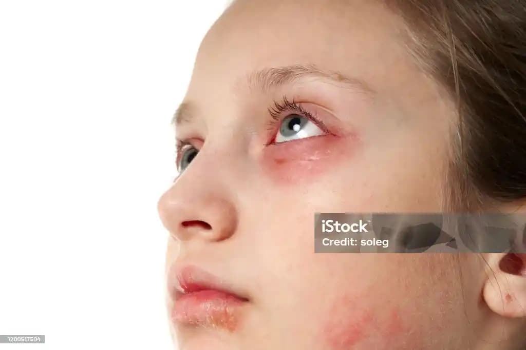 Dudaklarda Kızarıklık Nedenleri ve Güvenli Bakım Yöntemleri Hakkında Bilgiler