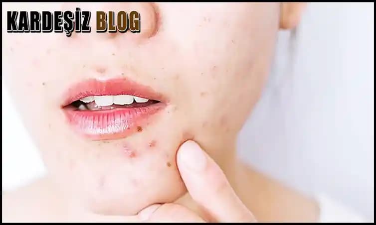 Dudaklarda Sivilce Nedenleri, Belirtileri ve Etkili Çözüm Yöntemleri