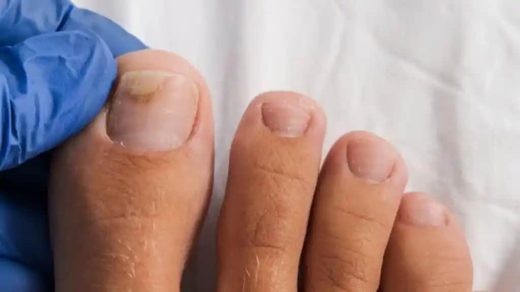 Düşen Tırnak Nasıl Çıkarılır Sağlıklı Tırnaklar İçin Uzman Rehberi