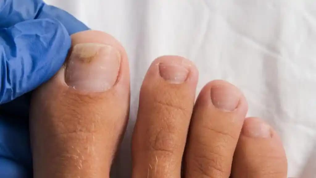 Düşen Tırnak Nasıl Çıkarılır Sağlıklı Tırnaklar İçin Uzman Rehberi